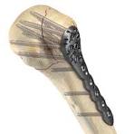 AxSOS 3 Ti Proximal Humerus | Stryker