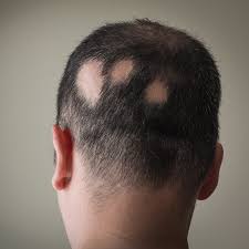 The condition of a severe hair loss, especially at the top of the head, due to stress, shock, traumatic events, or nutritional deficiency, is called telogen effluvium. Does Sleep Quality Have An Impact On Alopecia Areata Trichology