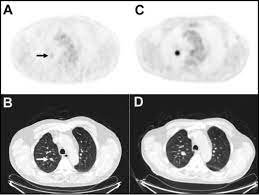 This usually heals on its own and will not require further procedures. For Early Stage Lung Cancer A New Biomarker And Treatment Target National Cancer Institute