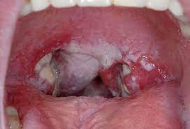 (in winter time when heater is running). Strep Throat Picture Image On Medicinenet Com