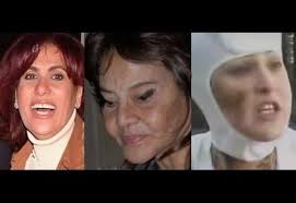 أعربتْ الفنانة اللبنانية، ليلى إسكندر، عن ندمها لإجراء عمليه تجميل لشفتيها، موضّحة، أنّ النتيجة لم تكن مرضية تمامًا، وغيّرتْ ملامحها للأسوأ. Ø¨Ø§Ù„ØµÙˆØ± Ø¹Ù…Ù„ÙŠØ§Øª ØªØ¬Ù…ÙŠÙ„ ÙƒØ§Ø±Ø«ÙŠØ© Ù„ÙÙ†Ø§Ù†Ø§Øª Ø¹Ø±Ø¨ÙŠØ© Referencetv