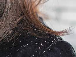 'a dry scalp does not directly cause hair loss, however, dryness can cause flakiness, irritation, inflammation, itchiness and maybe dandruff' dr bessam farjo, hair restoration surgeon & hair loss expert. Can Dandruff Lead To Hair Loss The Link Causes And Treatments