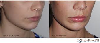 Home » lip augmentation » lip filler aftercare: 10 Things To Know Before Getting Lip Injections