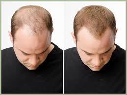 Half of men start to lose hair by age 30: If You Are Consistently Dehydrated Your Hair Will Be So Brittle That No Amount Of Moisturizing Can Fix I Hair Growth Regimen Hair Loss Treatment Hair Loss Men