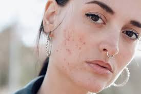 You may need treatment for several months to clear spots. Acne Face Map What Your Skin Breakouts Are Telling You