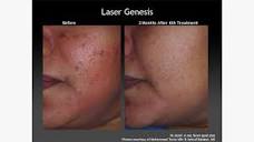 Laser Genesis: Procedure, Cost, and What to Expect