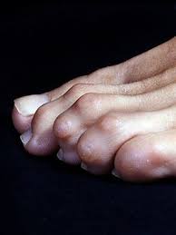 10 Common Foot Problems Everyday Health
