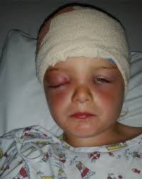 Cancers can be caused by dna changes that turn on oncogenes or turn off tumor suppressor genes. Mum Horrified That Son S Swollen Eye Was Caused By Brain Tumour That Took Months To Diagnose Huffpost Uk Parents