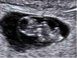 I think it is quite a long scan (bout 20 mins or so) plently of time to see baby wiggling around x 0 Dating Scan 7 10 Week Ultrasound Sydney Ultrasound For Women