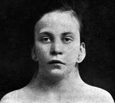 Turner syndrome • LITFL • Medical Eponym Library