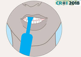 If your area is affected by variants of concern such as the 'south african' variant, and you are taking part in enhanced testing, do not put your. High Uptake Of Hiv Self Testing By Men Who Have Sex With Men And Transgender Women In Burma Aidsmap