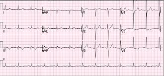 Want to find out the full story behind this ecg?. A 54 Year Old Man With An Nstemi And Upcoming Non Cardiac Surgery American College Of Cardiology