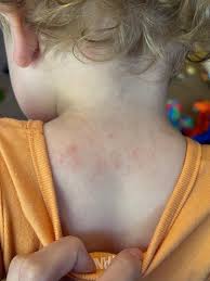 Image result for sweat rash on back