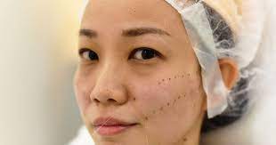 شد الوجه بالخيوط قبل وبعد مميزات نصائح و اضرار شد الوجه بالخيط بشرة وشعر thread lift face baby face facelift