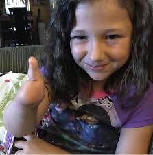 Lucky Fin Project is celebrating Limb Difference Awareness throughout the  month of April in an inclusive effort to recognize the limb different  community (upper, lower, congenital and amputee). Approximately 2,250  children are