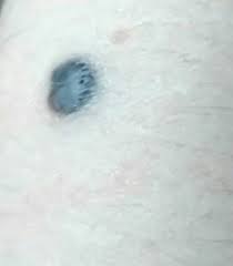 Image result for Blue Nevus