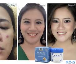 Very happy with the cream. Say Goodbye To Acne And Acne Scar Here Is What Lina Chief Marketing Officer Of Indonesia S Leading Publishing Company Has To Say I Often Have To Do Stage Presentations And My Persistent