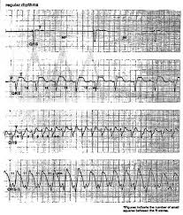 Ekg Interpretation