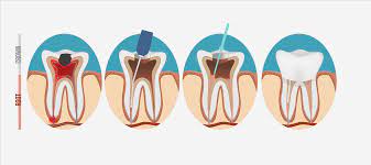 Root canal treatment to fix and spare a seriously harmed or contaminated tooth as opposed to evacuating it. Do I Need A Crown After A Root Canal Caffaratti Dental Group