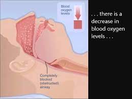 This pressure splints the throat airway open, and allows for normal breathing. How Cpap Works 5 23 11 Wmv Youtube