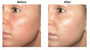 How often should i do micro needling. Microneedling Washington Institute