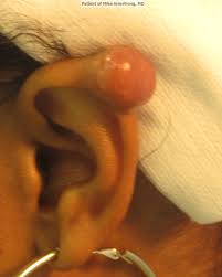 Piercing growths (big or small) are never normal, although they do occur fairly often. Scars And Torn Earlobes Richmond Facial Plastics