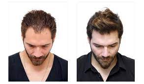 Why More Men Are Choosing A London Hair Transplant Clinic