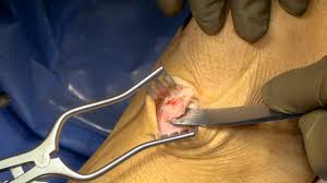 Osgood Schlatter Ossicle Resection And Tuberoplasty With Suture Anchor Repair Of Patellar Tendon Youtube