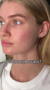 Acne Scar Treatment for Camera-Ready Skin