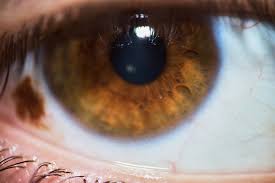 Image result for melanosis sclera