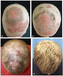Telogen effluvium and anagen effluvium. Fda Approved Arthritis Drug Spurs Hair Growth
