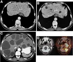 A Rapidly Progressing Polycystic Liver Disease Gastroenterology