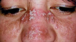 Eular recommendations for the management of systemic lupus erуthematosus. Discoid Lupus Erythematosus Primarily Affects Your Skin