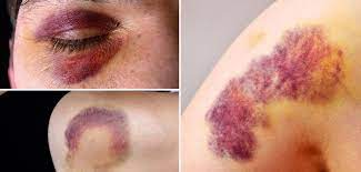 Blutung Wann Sie Mit Einem Blauen Fleck Zum Arzt Mussen Welt