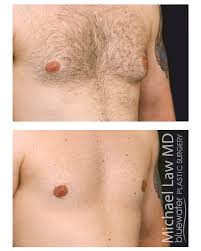 Image result for Gynecomastia
