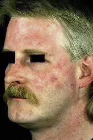 Image result for Photodermatitis