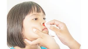 Image result for Epistaxis