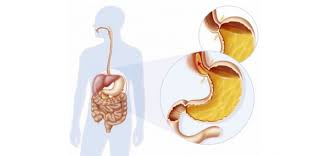Vous souffrez de ballonnements ? Reflux Gastrique Definition Symptomes Traitement Sciences Et Avenir
