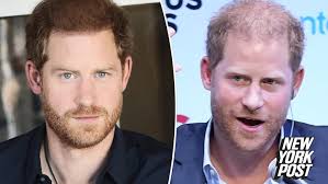 Prince Harry could be balding due to ...