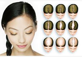 This type of yeast can cause inflammation and further damage to hair follicles if a lot is produced and left untreated. Female Hair Loss Causes What Causes Hair Loss In Women