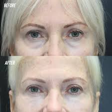 Love this lower face transformation. Using just 3cc's of product, we were  able to enhance jawline definition and improve the prominence and  projection of the chin. Coupled with a little Botox in