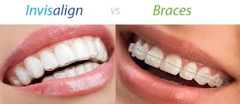 Our patients have their sutures (stitches) removed at around 14 days after surgery and then can go on with their lives as normal. Invisalign The Hidden Facts Is Invisalign Effective