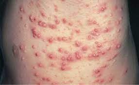All 3 forms can be associated with monoclonal immunoglobulin (mig). Eruptive Xanthoma Causes Symptoms Diagnosis Treatment