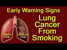 Smoking accounts for as much as 90% of lung cancers. Lung Cancer From Smoking Early Warning Signs Youtube