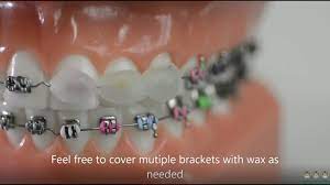 How do you use dental wax? How To Use Dental Wax On Braces Evolution Orthodontics Youtube