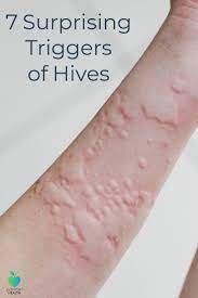 7 Surprising Triggers Of Chronic Hives Everyday Health Chronic Hives Natural Cough Remedies Hives Remedies