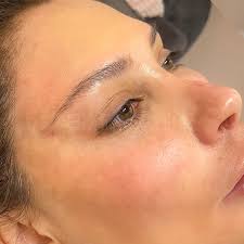Given here is an example of blepharoplasty, also known as the surgery for the rebuilding of the eyelids. Everything You Need To Know About The Fox Eye Procedure Spa And Beauty Today