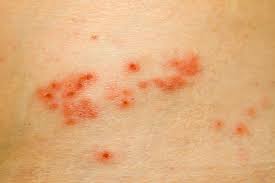 Image result for shingles in children