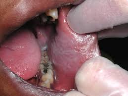 Image result for Leukoedema