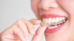 Scegli la consegna gratis per riparmiare di più. Invisalign Come Funzionano Le Mascherine Per Raddrizzare I Denti